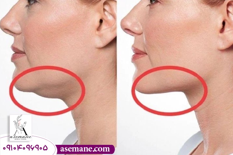 لیپوماتیک به عنوان روش سریع رفع غبغب 